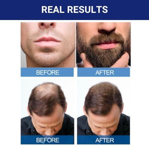 Kirkland Minoxidil 5% Extra Strength Men Hair Regrowth Solution 5 Month Supply Hair Care Serum