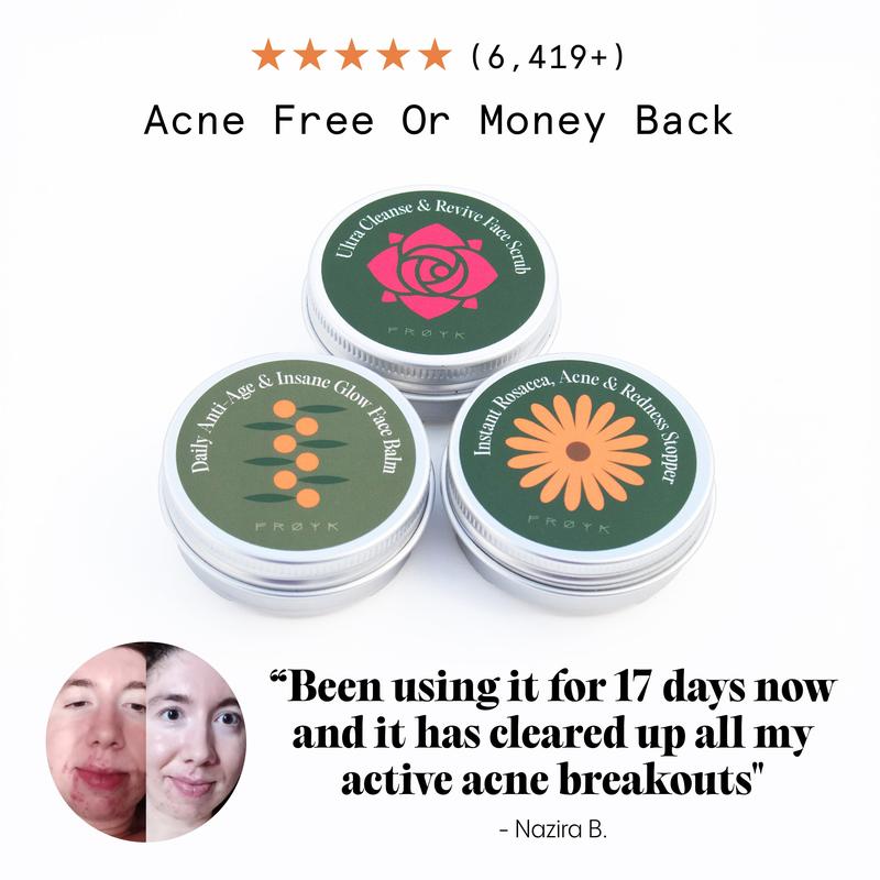 The Complete Acne System for Women-Natural Soothing Balm 3-Step Acne System for Women