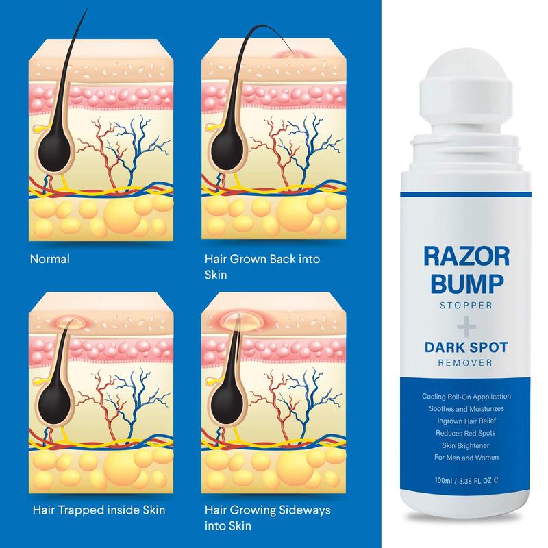 Razor Bump Stopper & Ingrown Hair Treatment: After Shave Solution for Razor Bumps, Burns, and Ingrown Hairs | Roll-on Applicator for Men & Women Aftershave Foam