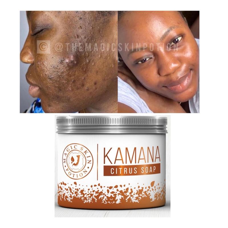 Kamana Citrus Soap for Skin Balance and Breakouts - Facial Cleansing - Skincare glowy skin care natural eczema