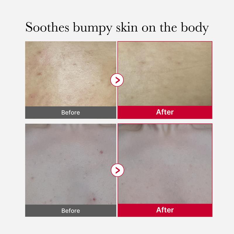 [Medicube Official] Red Body Peeling Shot Cleanser | Bloody Powerful Solution for Body Troubles: Skin Imperfections Vampire Wash-off Spray, Recommended for Décolleté Care