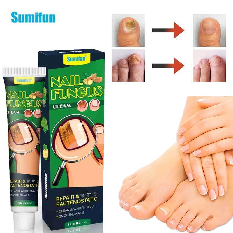 Healthy Nail Essencerepair gel, nail repair nail care nail art, treatmentof nail removal cream fungus infection paronychiaComfort Manicure Nail Polish ginger nail