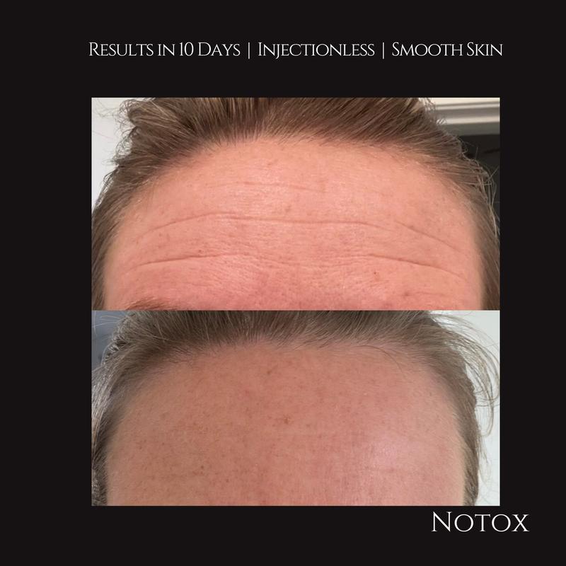 NOTOX Injectionless Wrinkle Reducing Peptide Infused Forehead Patch - 10 Patches Hydrate