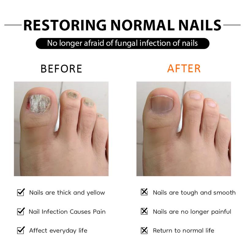 HEALMUSZ Nail Fungus Cream - Repair Damage and Fungal Infections - Clear and gentle recovery oregano tea Healthcare Treatment footcream