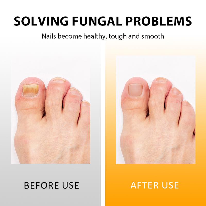 HEALMUSZ Nail Fungus Cream - Repair Damage and Fungal Infections - Clear and gentle recovery oregano tea Healthcare Treatment footcream