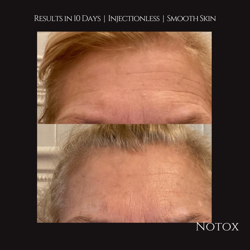 NOTOX Injectionless Wrinkle Reducing Peptide Infused Forehead Patch - 10 Patches Hydrate