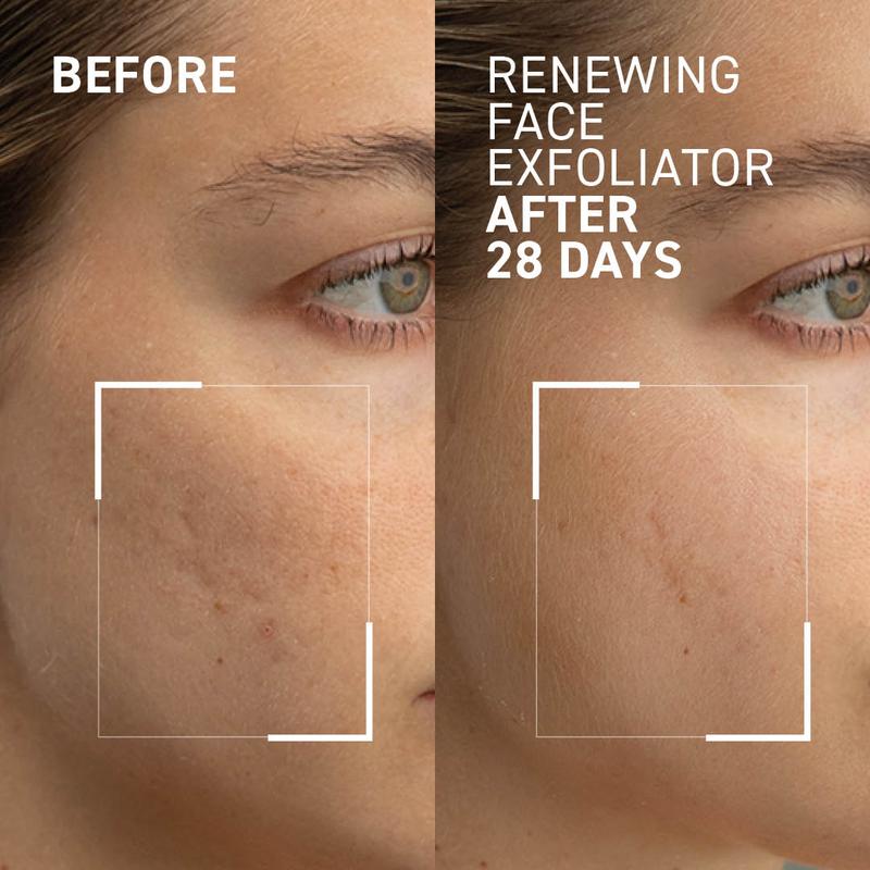 Microdermabrasion - Face Exfoliator - Combines Physical and Chemical Exfoliation to Reduce Dull Skin, Uneven Texture, Fine Lines, Acne Scars and Wrinkles