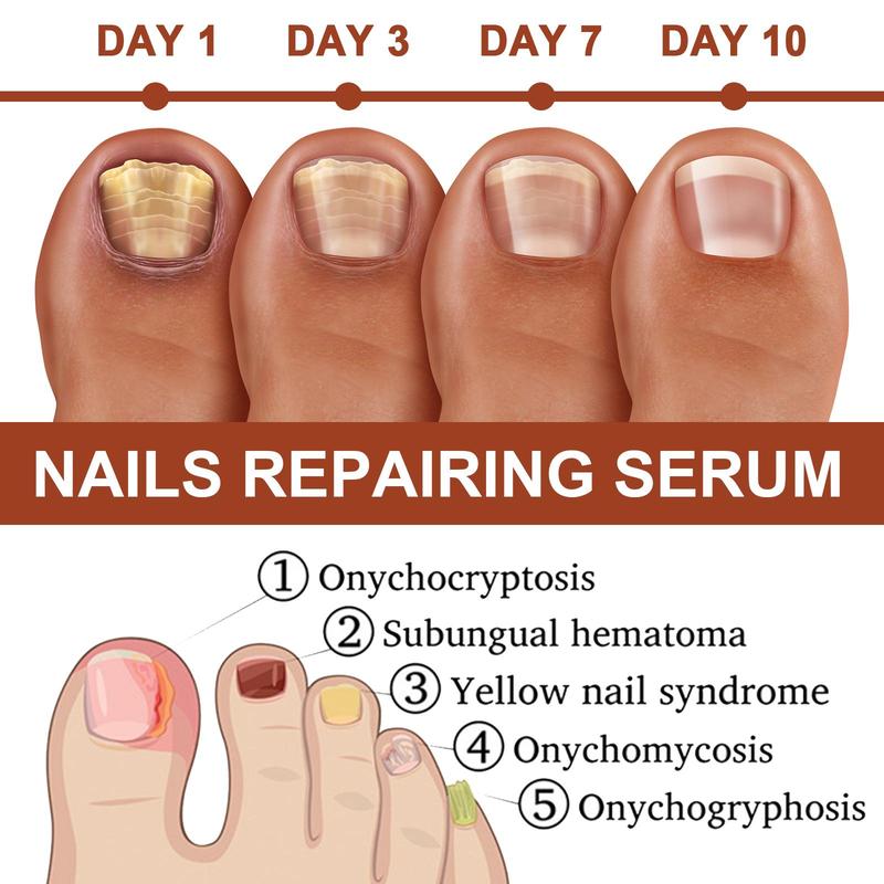 7 Days Nail Strengthening Serum, 2 Counts set Nail Care Essence, Nail Care Product for Women & Men, Professional Nail Strengthening Serum